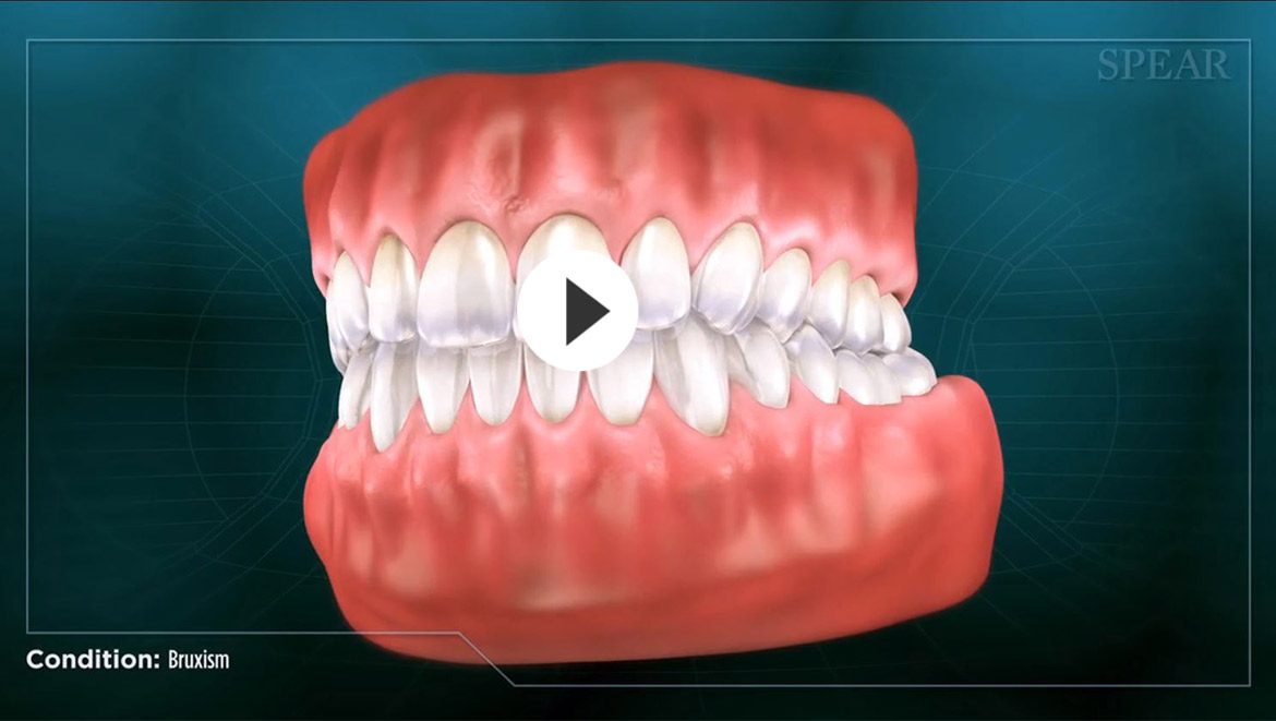 Bruxism Treatment Dentist in Bozeman, MT