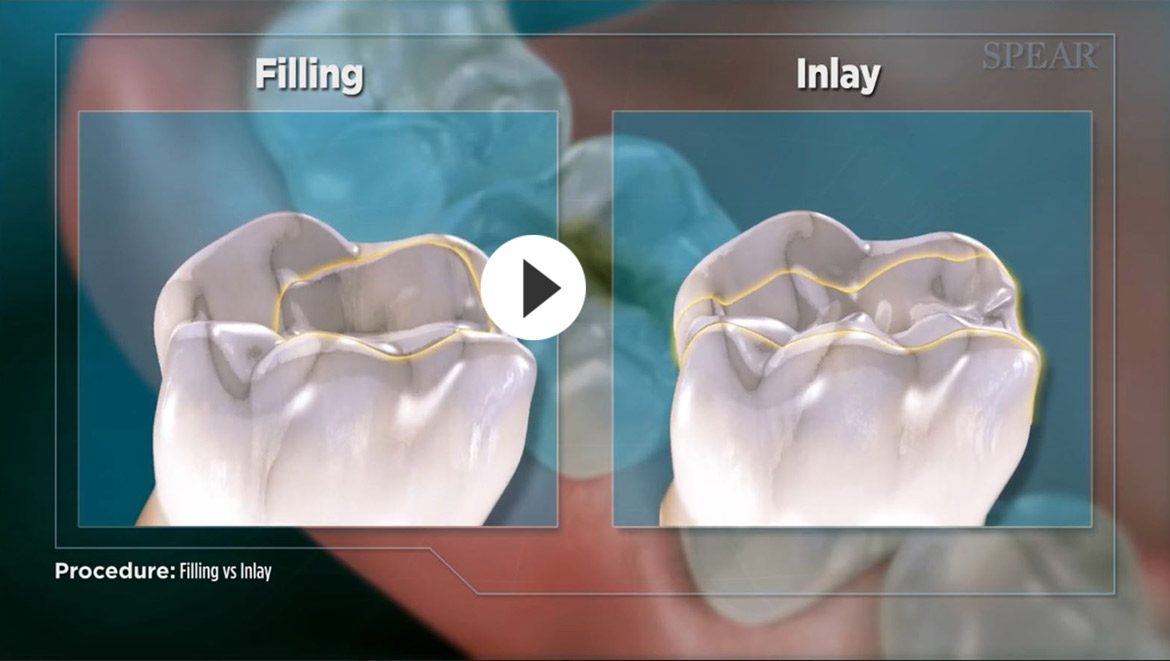 Dental Inlays & Onlays Dentist in Bozeman, MT